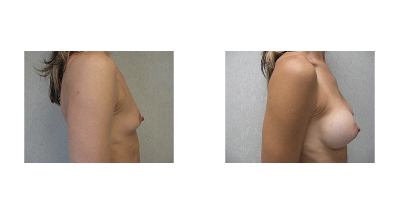 Breast Augmentation width='800