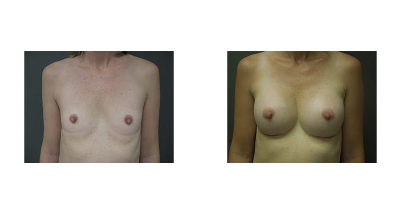 Breast Augmentation width='800