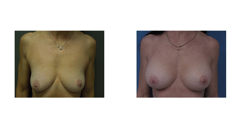 Breast Augmentation width='800