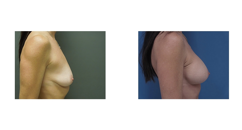 Breast Augmentation width='800