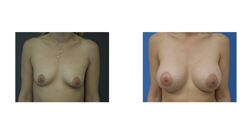 Breast Augmentation width='800