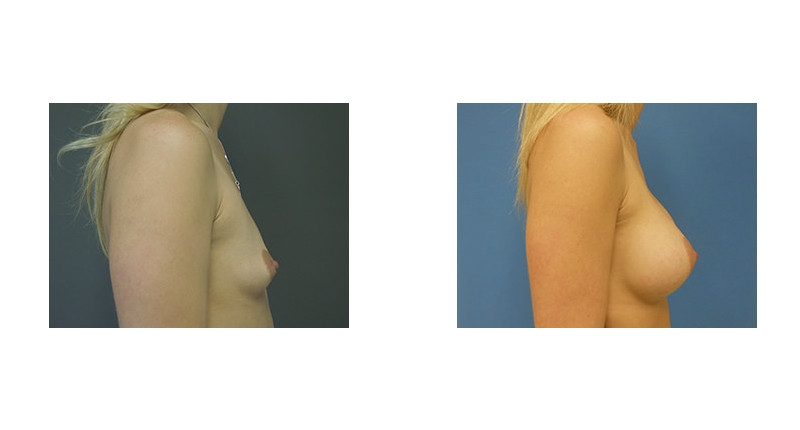 Breast Augmentation width='800