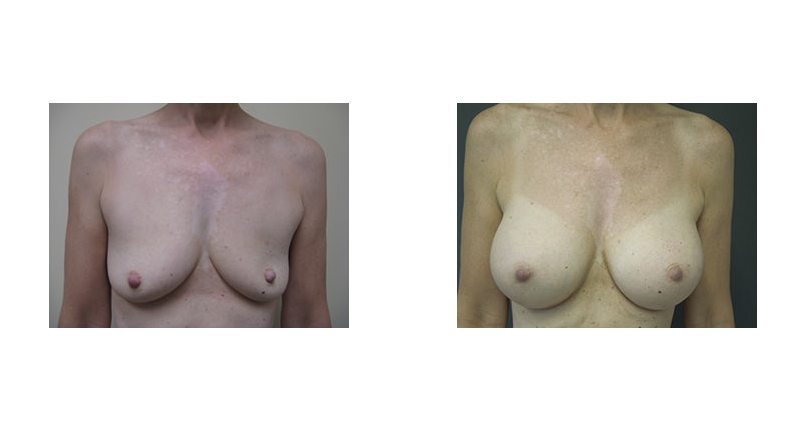 Breast Augmentation width='800