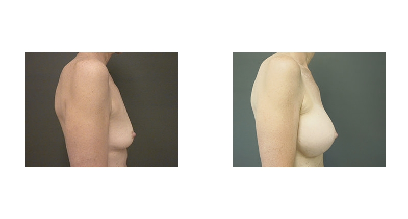 Breast Augmentation width='800