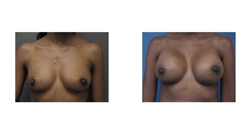 Breast Augmentation width='800