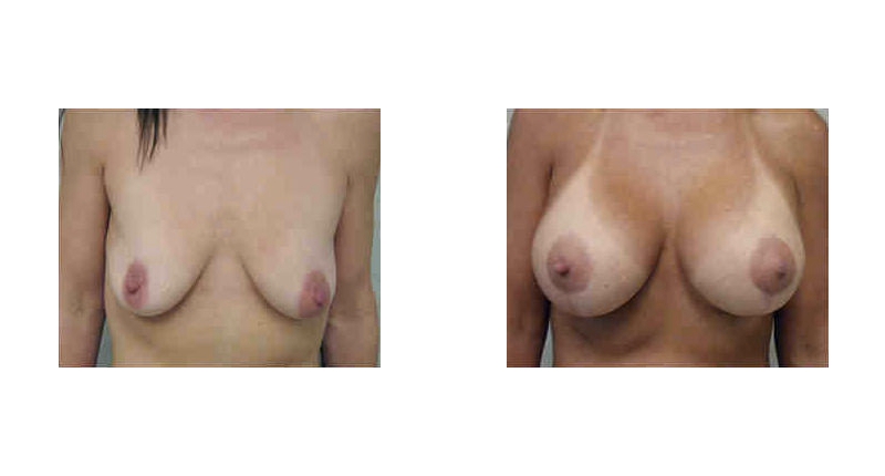 Breast Lift width='800