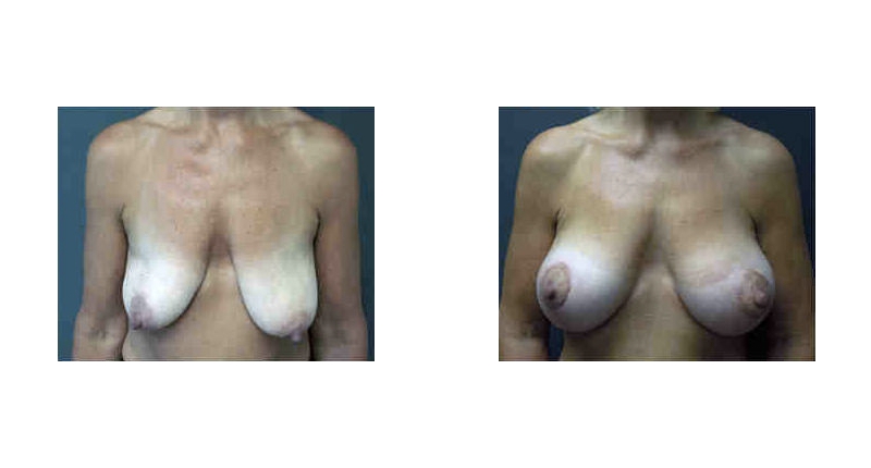 Breast Lift width='800