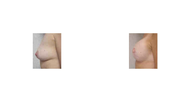 Breast Reconstruction width='800