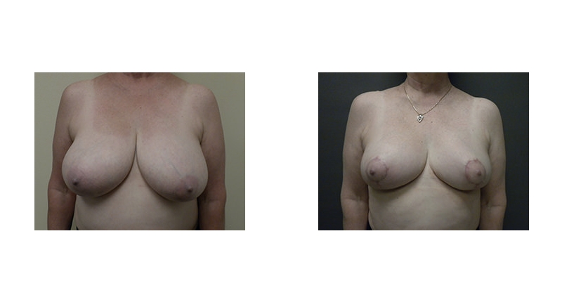 Breast Reduction width='800