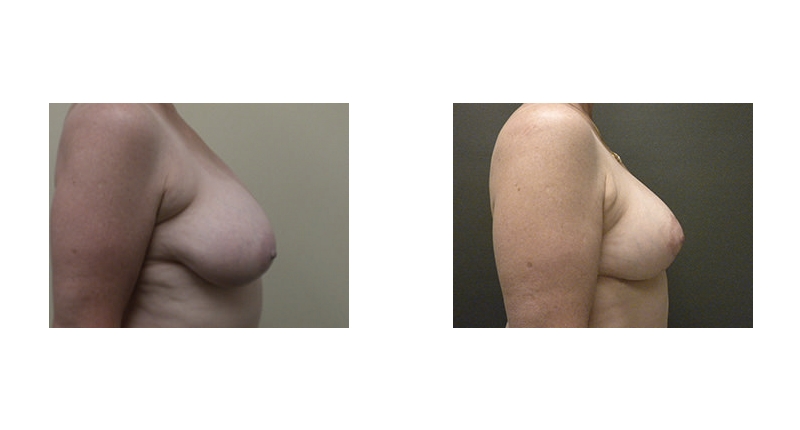 Breast Reduction width='800