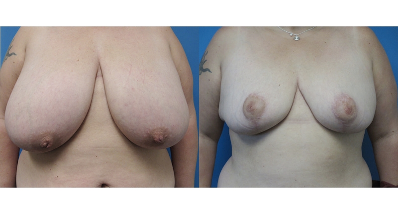 Breast Reduction width='800