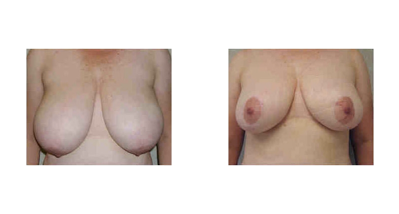 Breast Reduction width='800