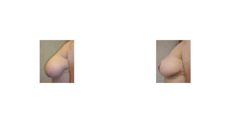 Breast Reduction width='800