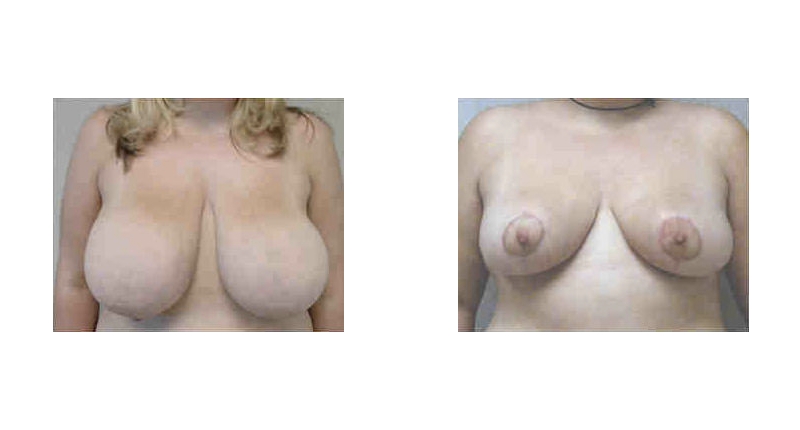 Breast Reduction width='800