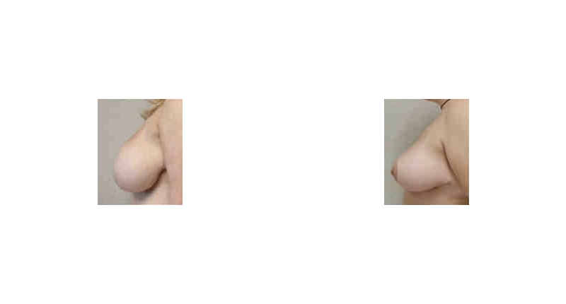 Breast Reduction width='800