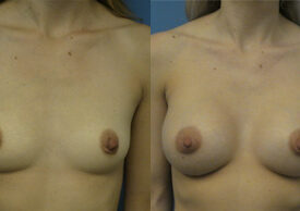 Breast Augmentation