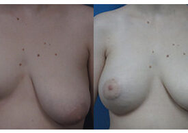 Breast Augmentation