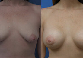 Breast Augmentation