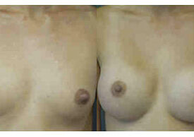 Breast Augmentation