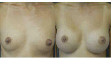 Breast Augmentation