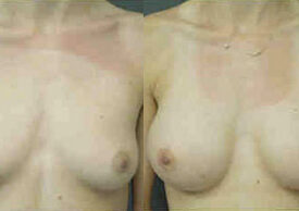 Breast Augmentation