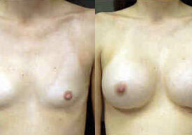 Breast Augmentation