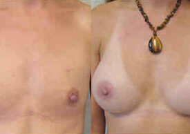 Breast Augmentation