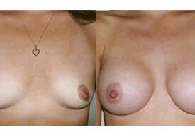 Breast Augmentation