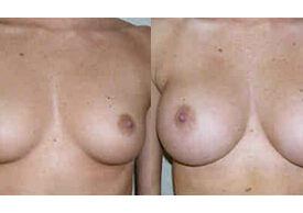 Breast Augmentation