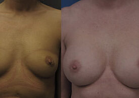 Breast Augmentation