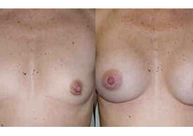 Breast Augmentation