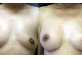 Breast Augmentation