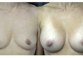 Breast Augmentation