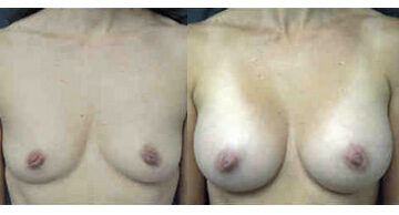 Breast Augmentation