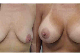 Breast Augmentation