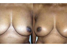 Breast Augmentation