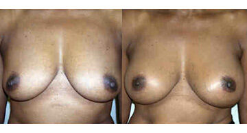 Breast Augmentation