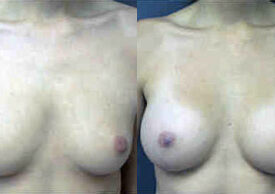 Breast Augmentation