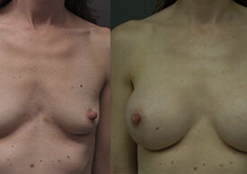 Breast Augmentation