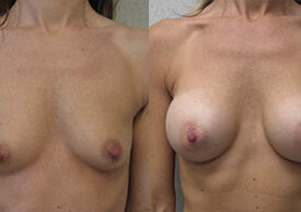 Breast Augmentation