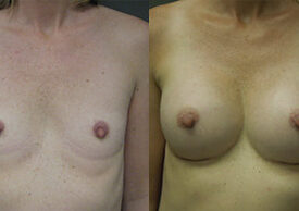 Breast Augmentation