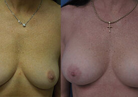 Breast Augmentation