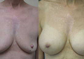 Breast Augmentation