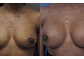 Breast Augmentation