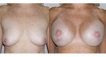 Breast Reconstruction