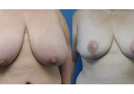 Breast Reduction