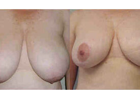 Breast Reduction