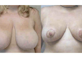 Breast Reduction