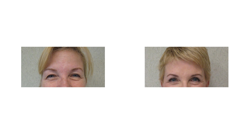 Brow Lift width='800