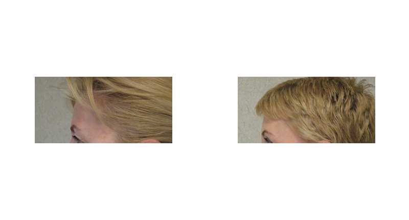 Brow Lift width='800